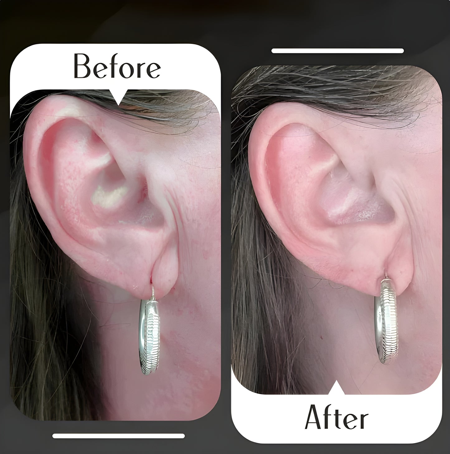 Premium Earlobe Support Patches (150 PCS)